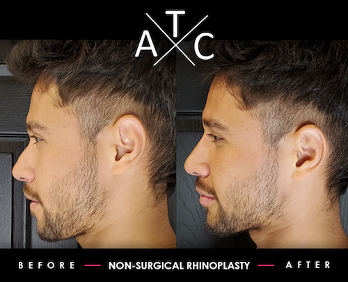Non-Surgical Rhinoplasty Training Results 1